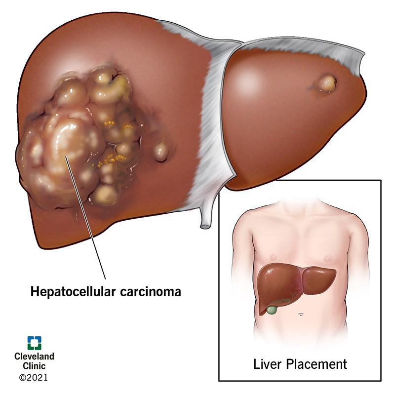 Liver Cancer