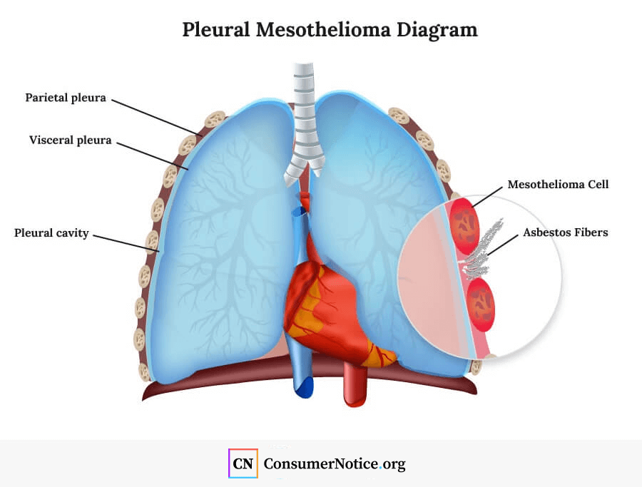 Mesothelioma Cancer