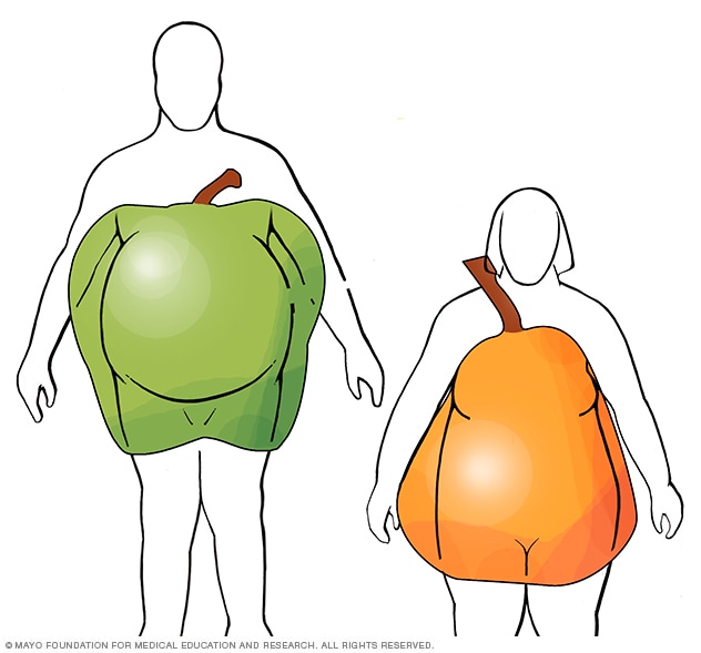 Metabolic syndrome