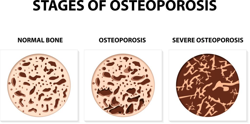 Endocrine Bone Disease