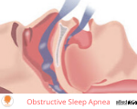 Snoring and Obstructive Sleep Apnea