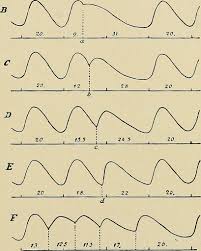 Arrhythmias