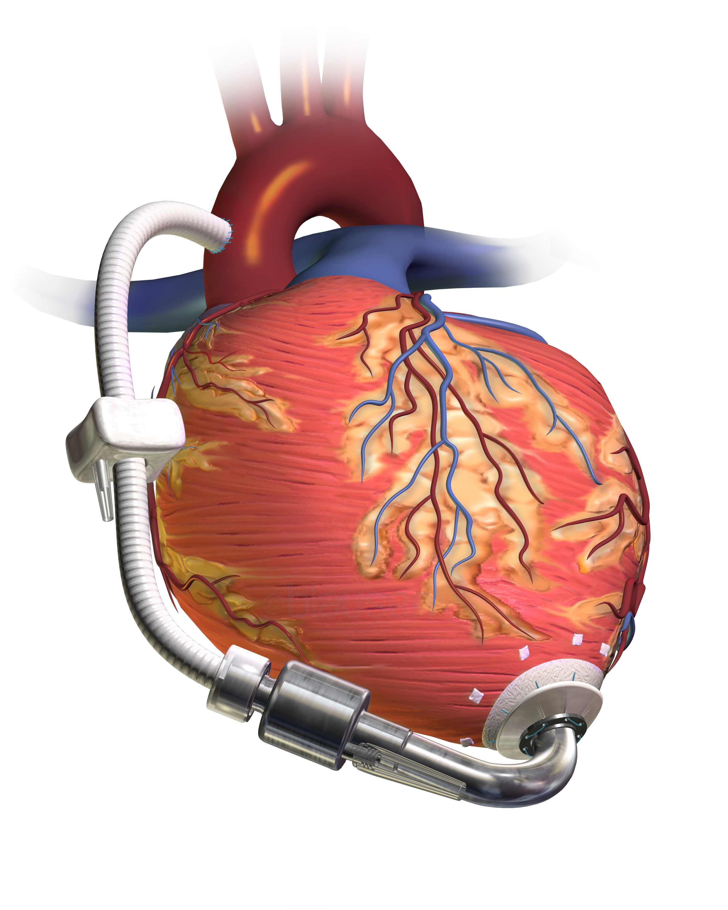 Cardiovascular devices and Instruments