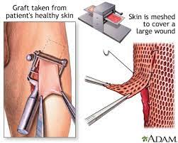 Skin Grafting