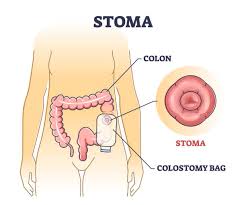 Wound Care and Ostomy
