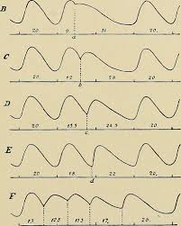 Arrhythmias