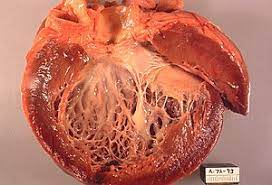 Cardiomyopathy and Heart Failure