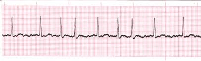 Atrial Fibrillation