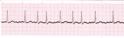 Atrial Fibrillation