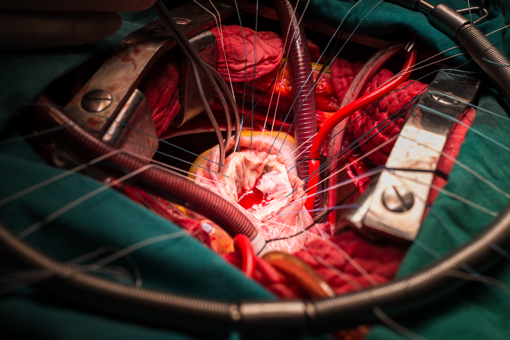 Cardiothoracic Surgery