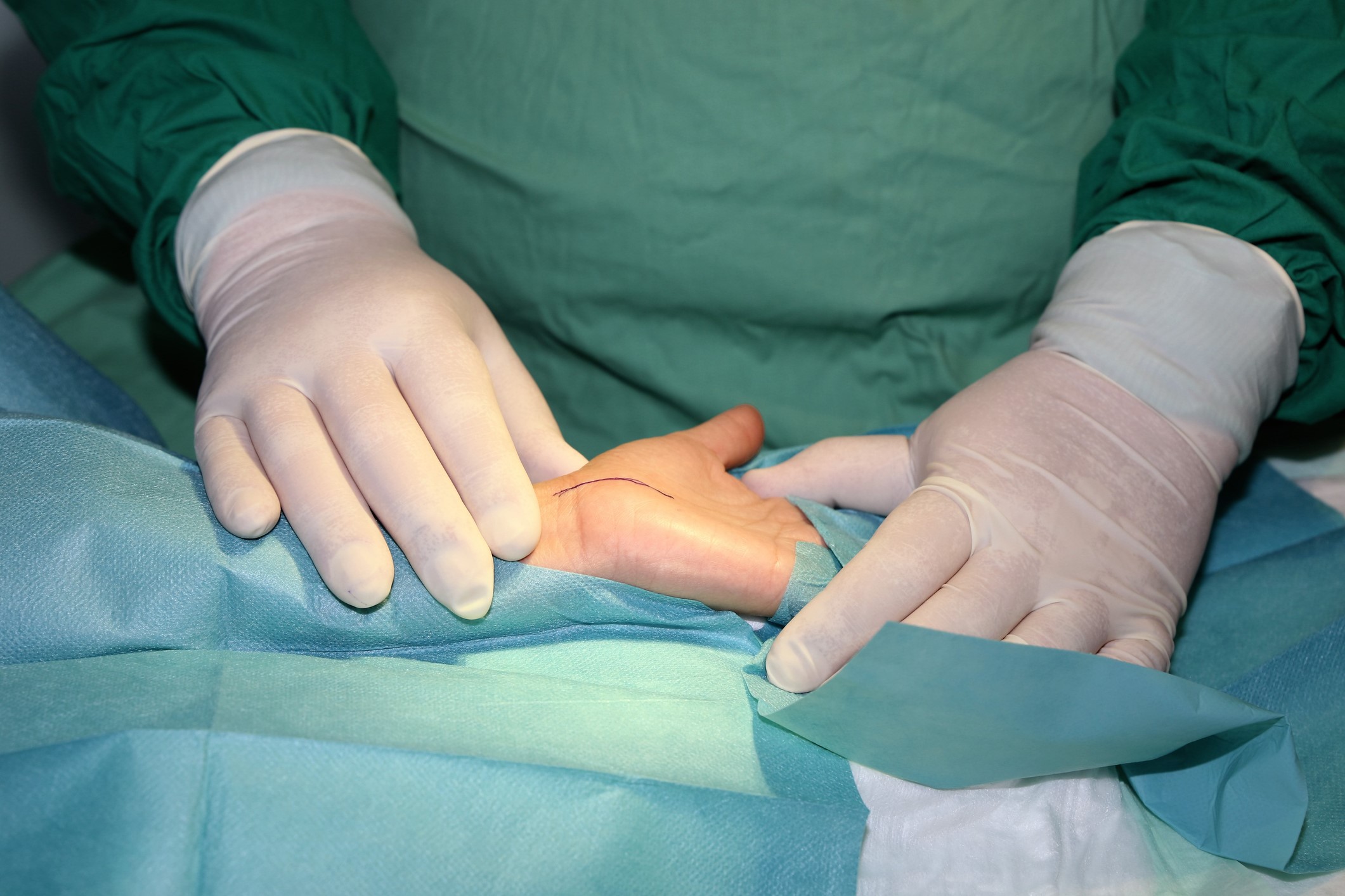 Hand Transplant Surgery