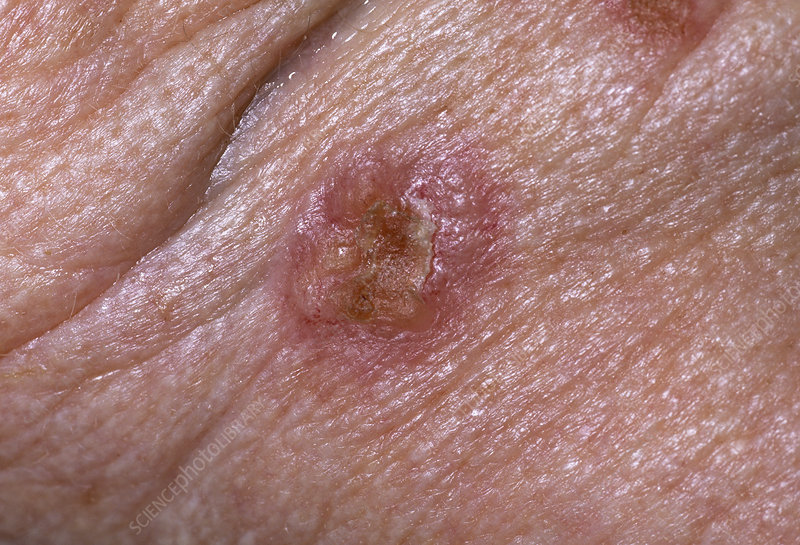 Dermatologic Cancer