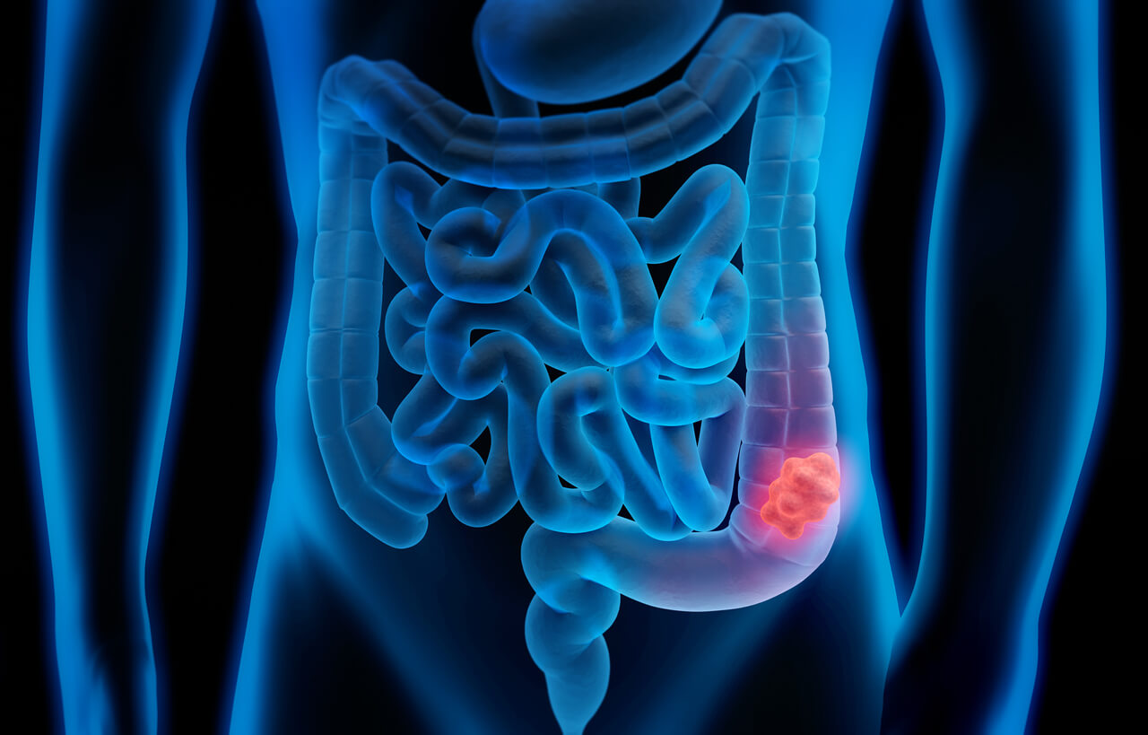 Cancer in Gastrointestinal Tract