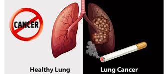 Lung Cancer